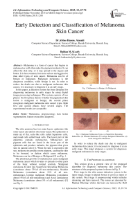 Early Detection and Classification of Melanoma Skin Cancer