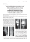 Клиническое наблюдение рецидивирующего переднего вывиха тибиального компонента эндопротеза коленного сустава